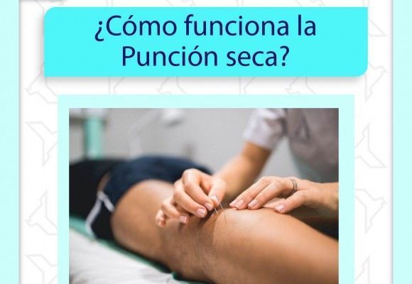 ¿Cómo funciona la punción seca?