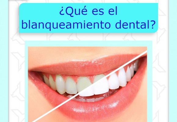 ¿Qué es el blanqueamiento dental?